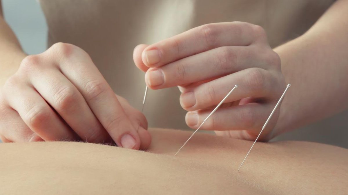 Acupuncture for stress relief: How a traditional therapy can enhance modern well-being